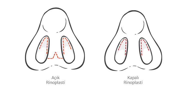 Açık Kapalı Rinoplasti istanbul